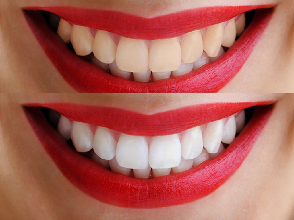 Отбеливание зубов, отбелить зубы, отбеливание зубов дома, отбеливание зубов в домашних условиях